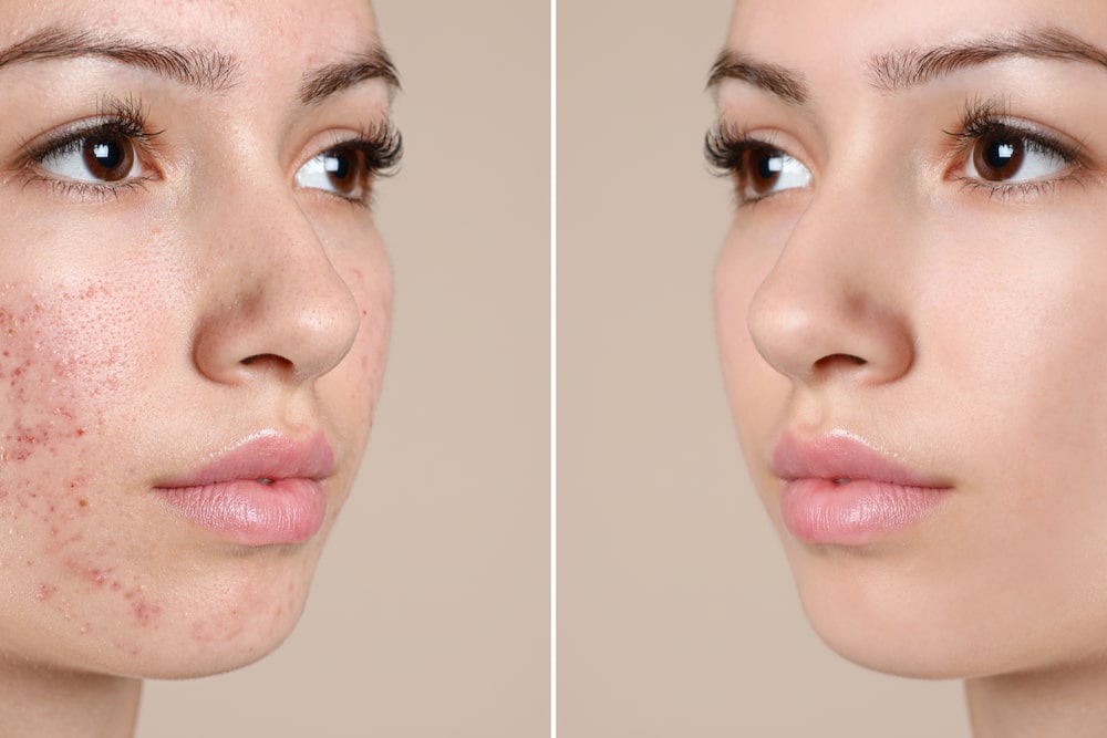 Teenage girl before and after acne treatment on beige background