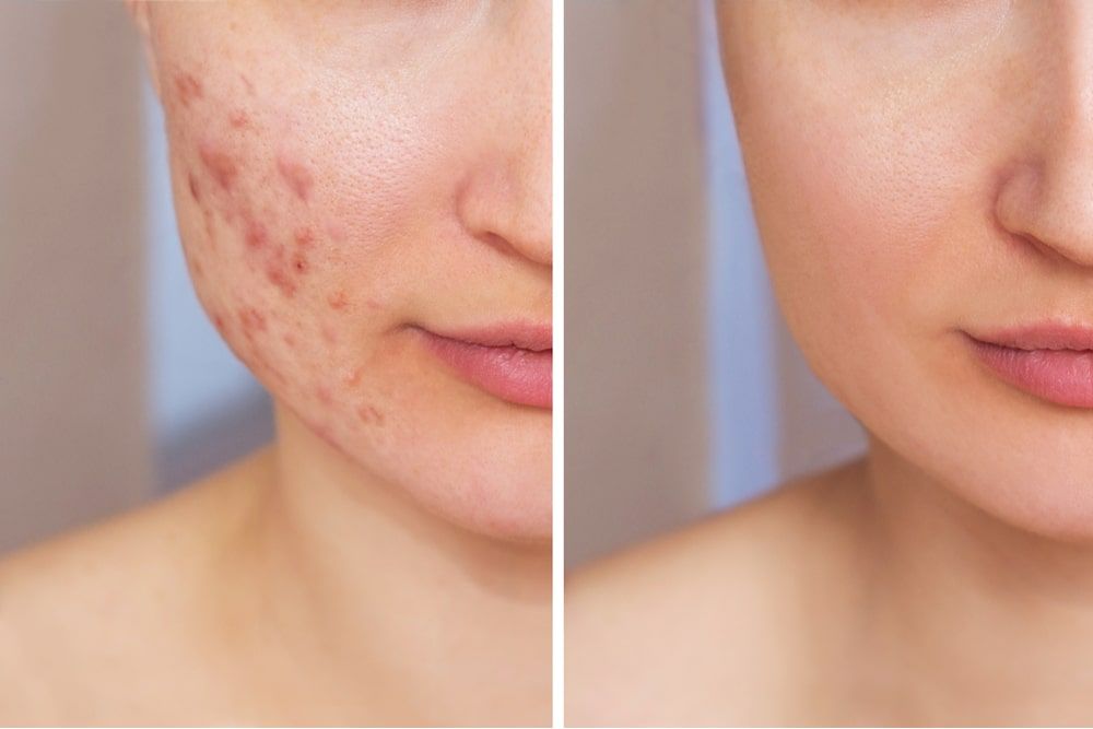 Cropped shot of a young woman's face before and after acne treatment