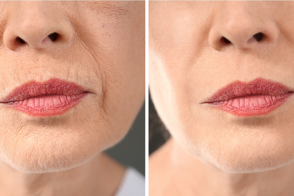 Senior woman before and after biorevitalization procedure, closeup