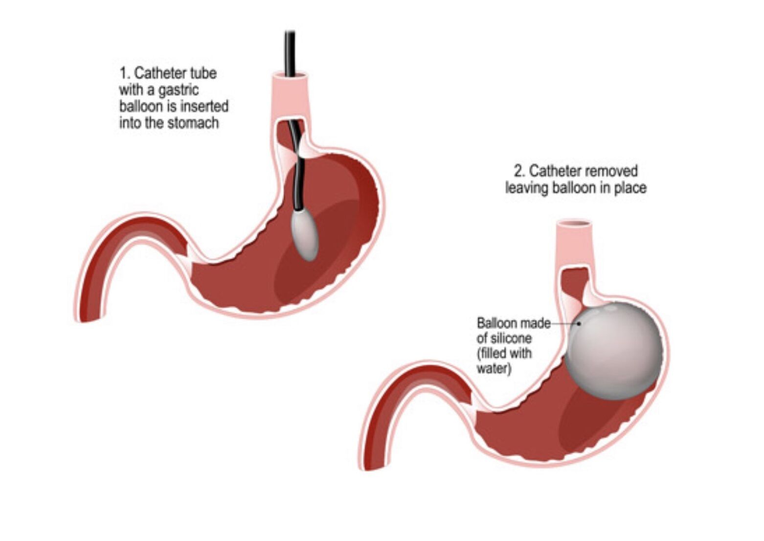 Intragastric Balloon Therapy East Bridgewater Ma Novacare Medical