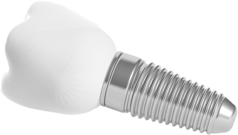 dental implant