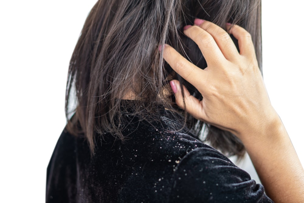 woman hair having problem with dandruff on shoulder