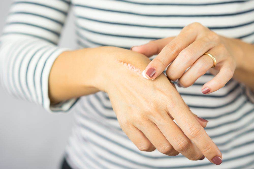 A woman looking at her hand deciding if she can get scar revision treatment