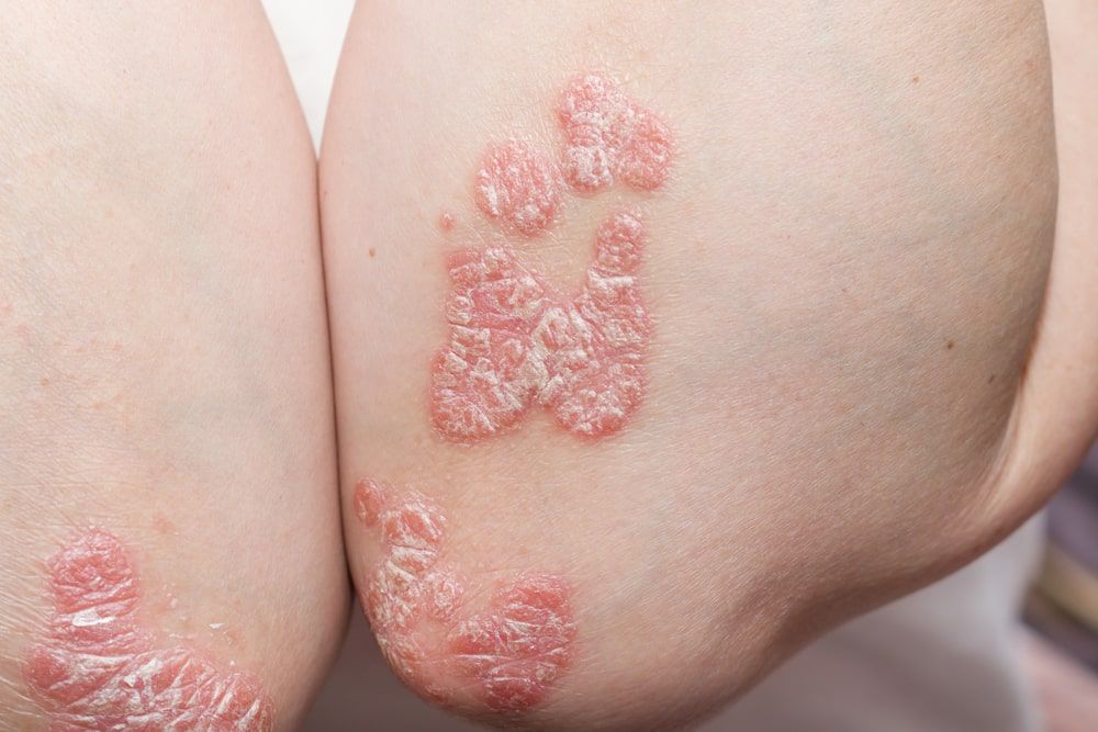 problem skin psoriasis on the body