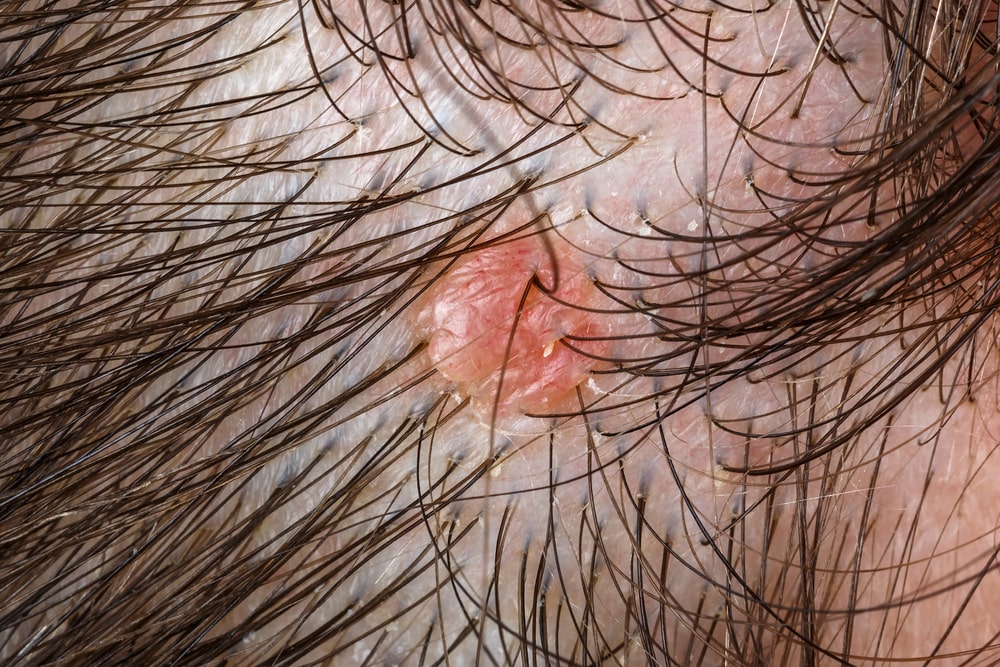 Close up photo of nevus sebaceus on scalp