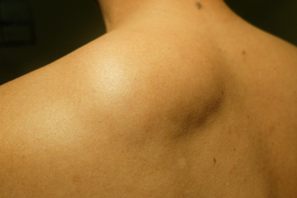 Lipoma of the shoulder back.