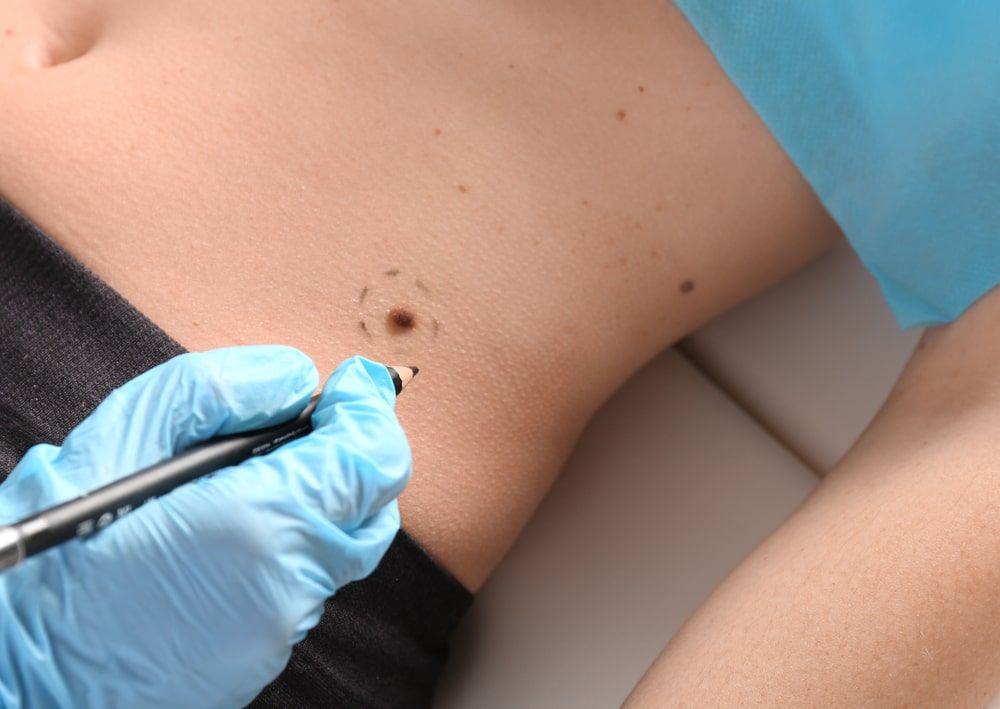 Dermatologist applying marks onto patient's skin before moles removal