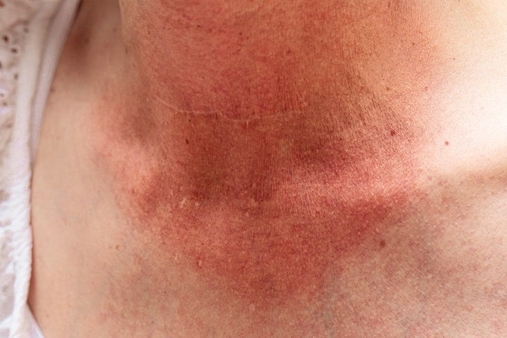 A closeup view on the sunburned skin of a caucasian lady