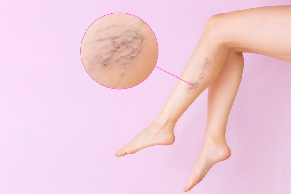 Female legs with varicose veins