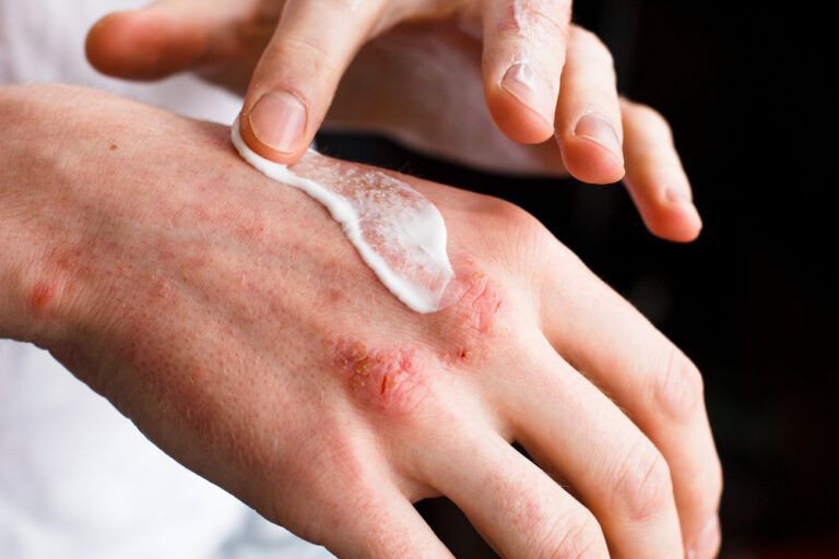 5 Tips to Prevent Eczema FlareUps Garden City, NY & Syosset, NY