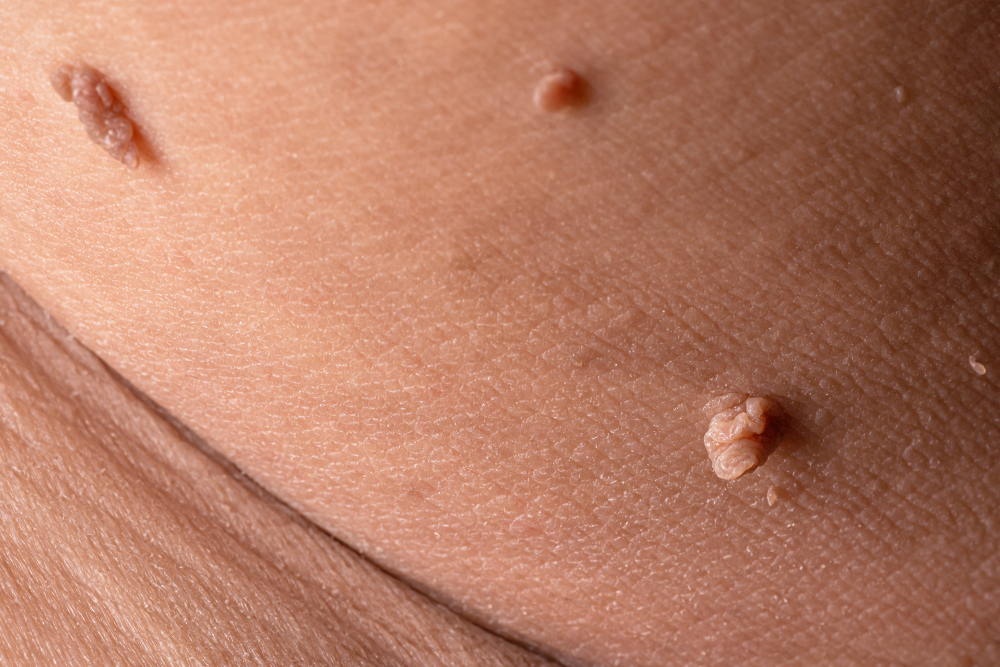 What is the difference between a wart and a skin tag? | Garden City, NY &  Syosset, NY | Borealis Dermatology