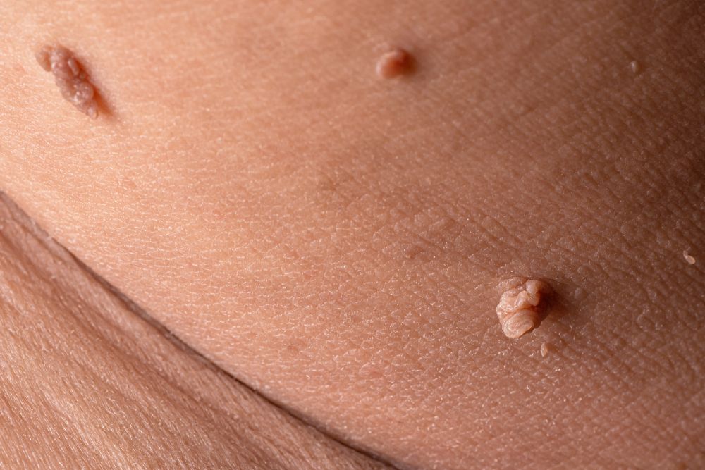 The difference between a wart and a skin tag