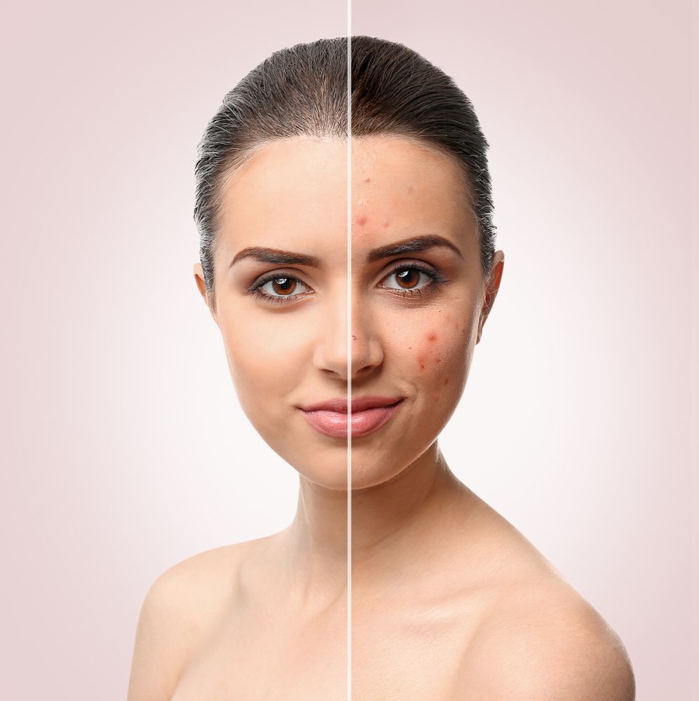 Radiant Skin with Acne Facials