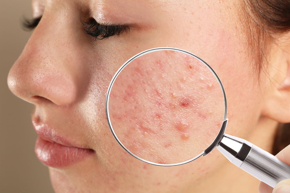 Decoding Acne with a dermatologist