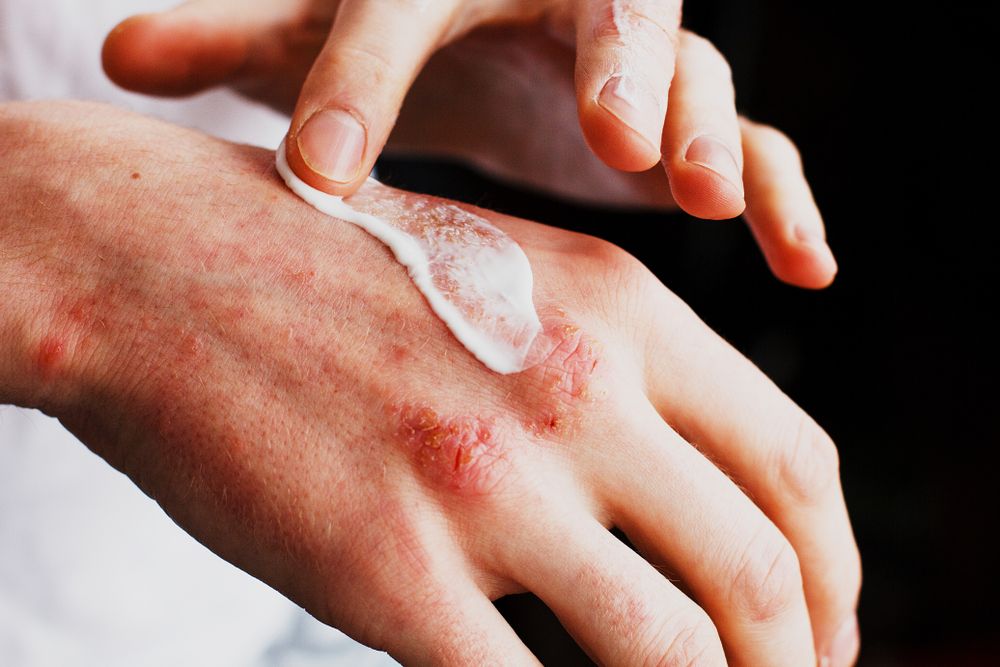 Different Types Of Eczema