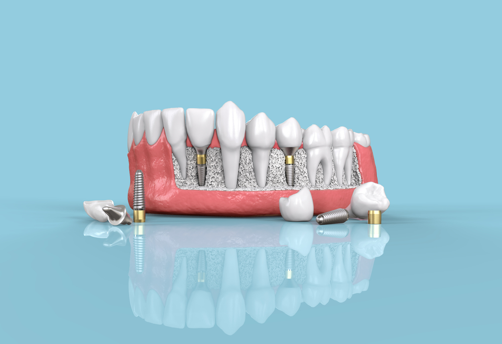 Tooth Dental Implant Model 3d Illustration