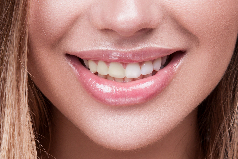 How Do I Know If I Need Teeth Whitening?