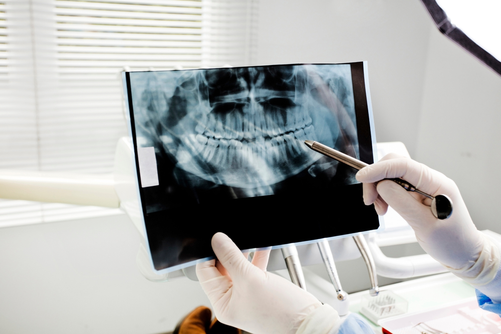 Why Dental X-Rays Are So Important