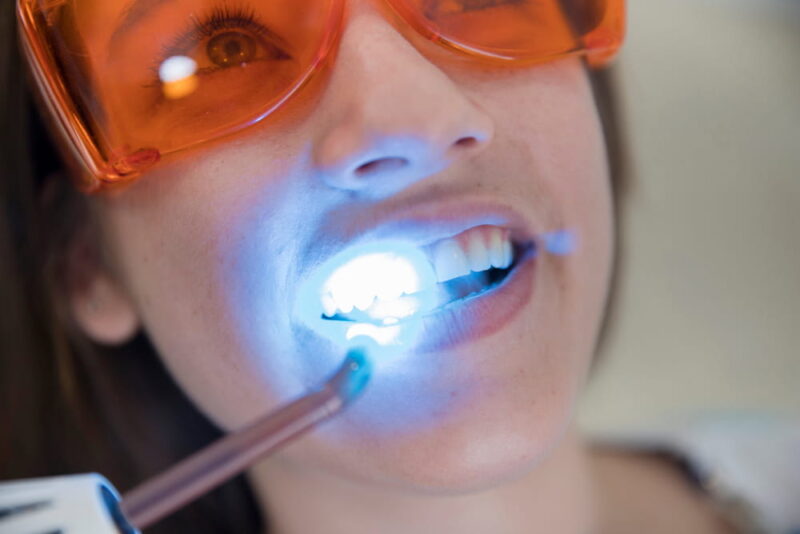 Girl patient in the dental clinic. Teeth whitening UV lamp with photopolymer composition