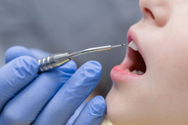 Close up of a diode laser tip near a child’s mouth during pediatric dental treatment, showing sterile, minimally invasive care.