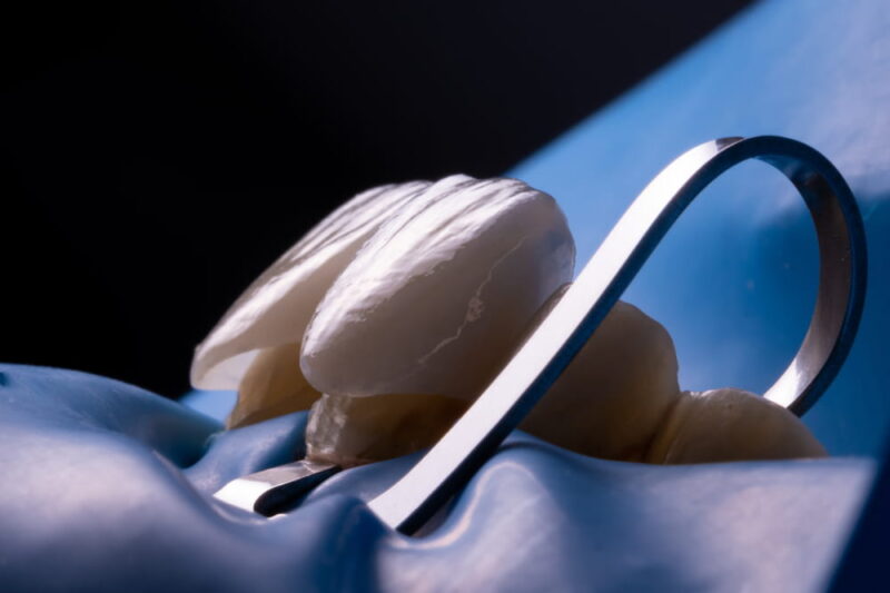 Try-in porcelain veneers, modified B5 clamp, silk blue rubber dam