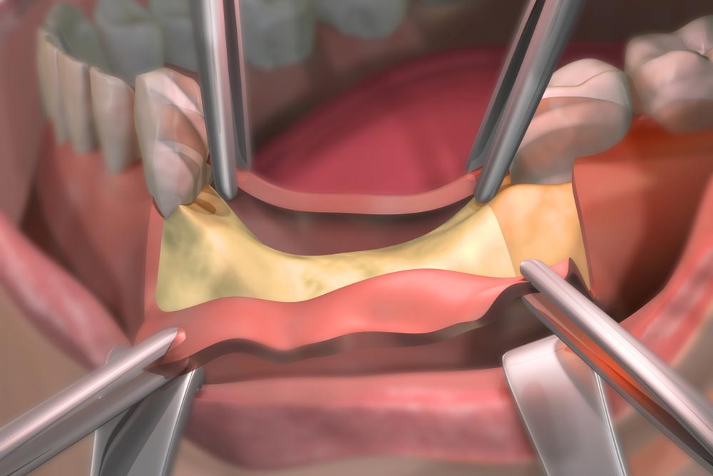 Bone Loss After Tooth Removal