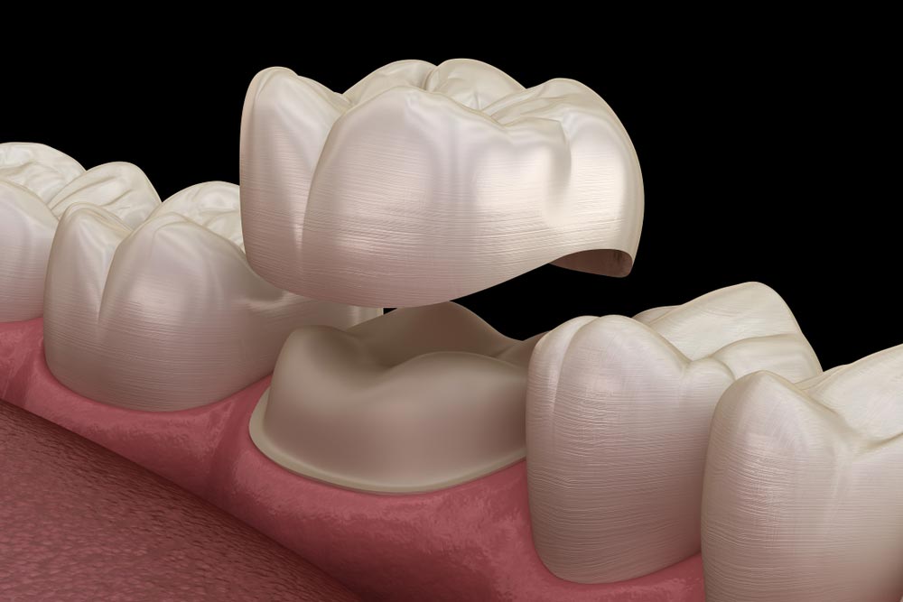 Preparated molar tooth for dental crown placement