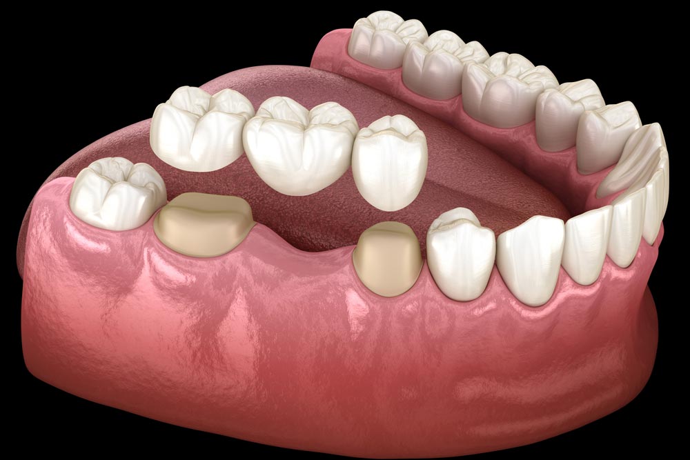 Preparated molar and premolar tooth for dental bridge placement