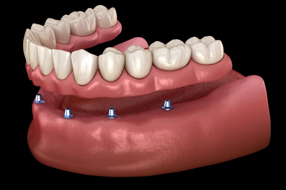 Mandibular prosthesis All on 6 system supported by implants