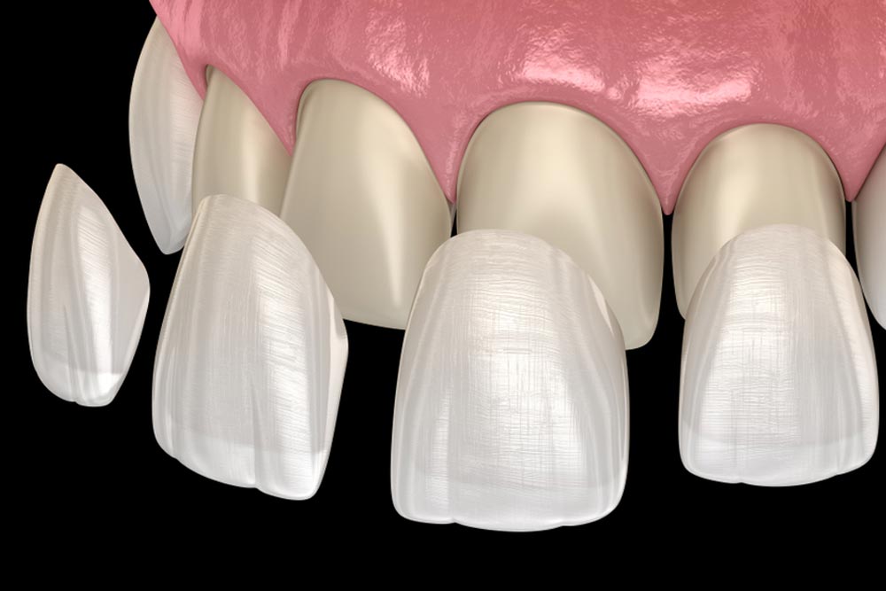 Veneer installation procedure over central