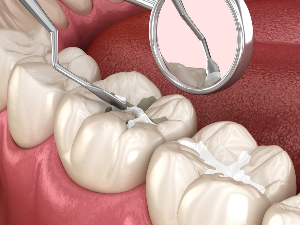 Molar tooth fissure restoration with filling