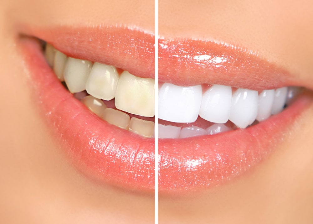 woman teeth before and after whitening