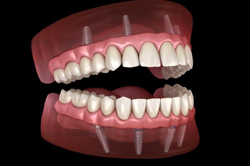 Long-Term Dental Implant Comfort: Expert Tips from Dr. Harmeet Mann