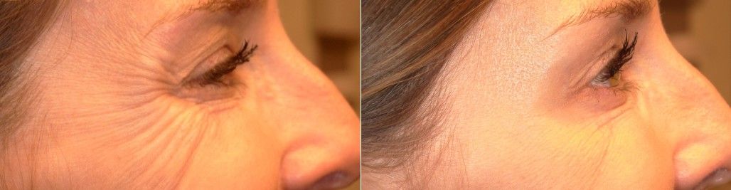 5 days post treatment with Xeomin before and after treatment results