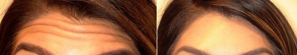 5 days post treatment with Xeomin before and after treatment results