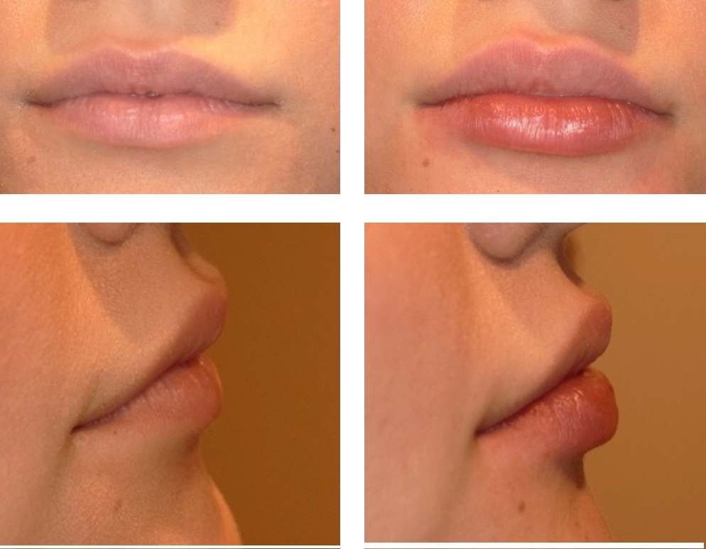 1/2 Syringe of Juvederm Vobella before and after treatment results