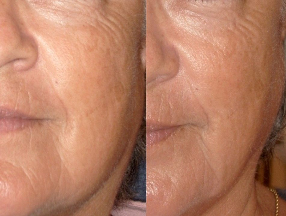 Anti-Aging before and after treatment results
