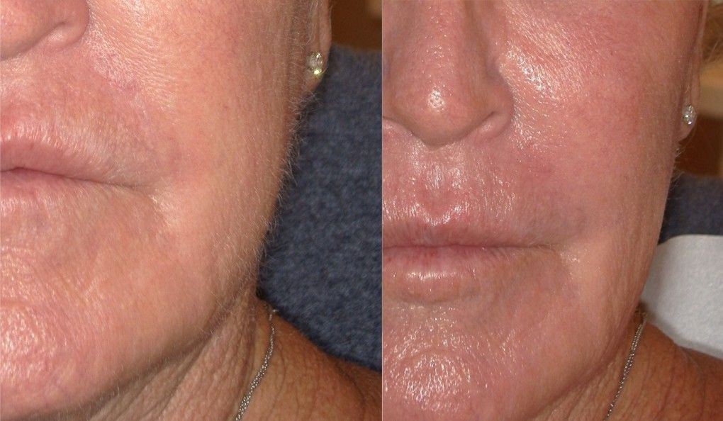 Dermaplaning before and after treatment results