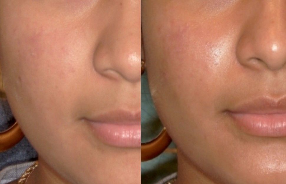 Hydrafacial before and after treatment results