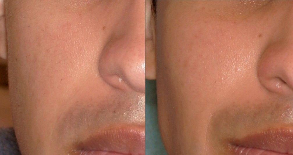 Hydrafacial with Dermaplaning before and after treatment results