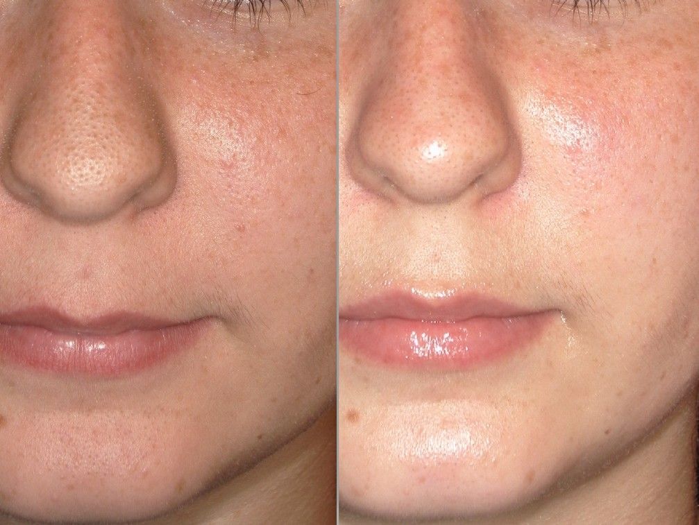 Microdermabrasion before and after treatment results