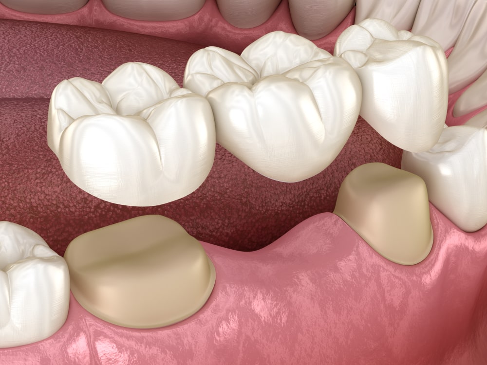 Dental bridge of 3 teeth over molar and premolar.