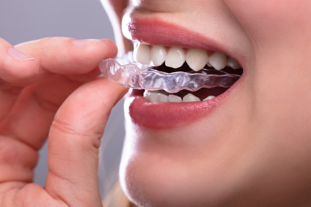 A Woman's Hand Putting Transparent Aligner In Teeth