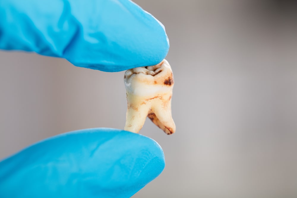 Dentist Hand In Glove Holding Decay Tooth