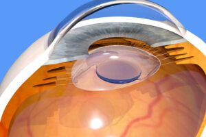 Intraocular lens implanted in the human eye