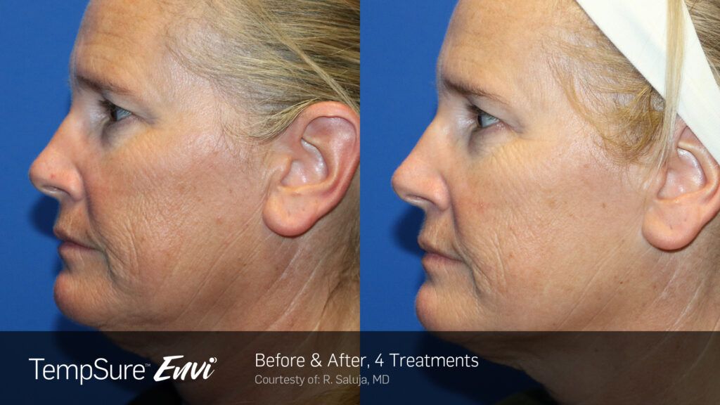 tempsure envi youthful lines and wrinkles gone