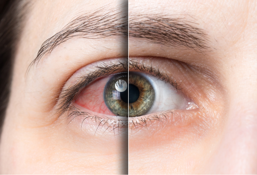 Red eye before and after treatment