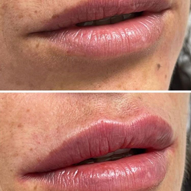 Lip Filler Before After