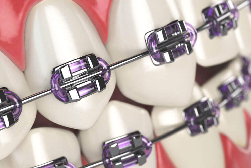 orthodontic bracket or brace