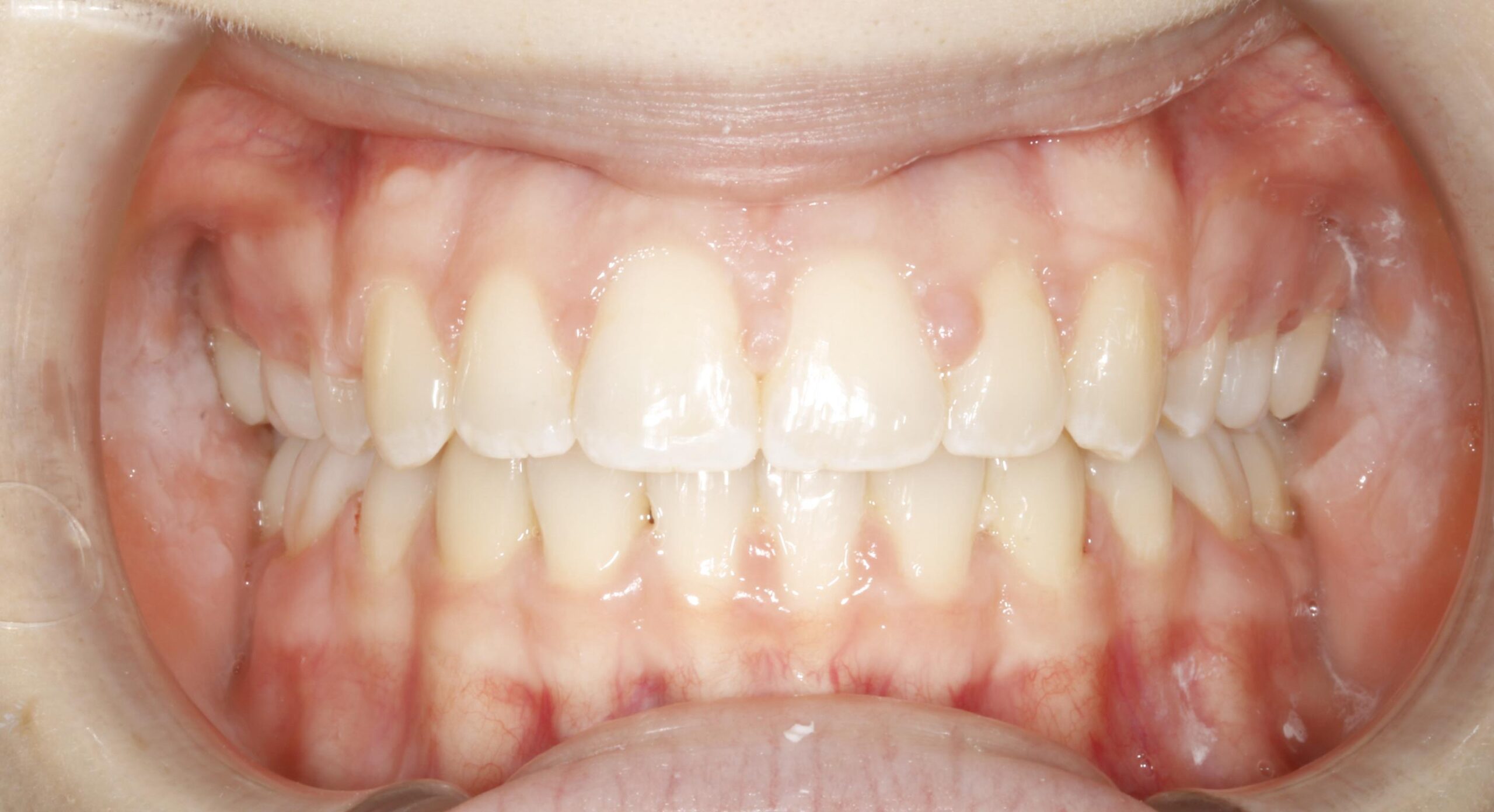 Orthodontic-Case treatment After